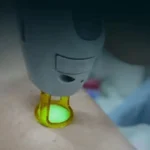 استخدام اپراتور لیزر کندلا جهت کلینیک زیبایی در یاسوج
