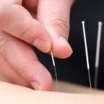 استخدام دکتر طب سوزنی در خیابان درختی تهران