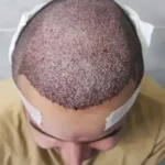 استخدام دستیار کاشت مو جهت کلینیک پوست و مو در کرمانشاه