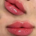 نیازمند تکنسین تزریق فیلر و بوتاکس جهت کلینیک زیبایی زیر نظر پزشک در پادادشهر اهواز