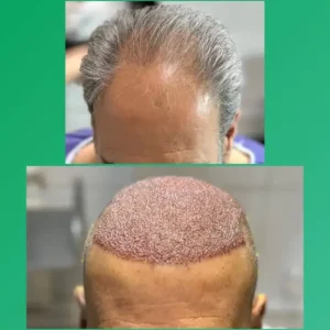 استخدام دستیار حرفه ای کاشت مو جهت کلینیک در کیانپارس اهواز