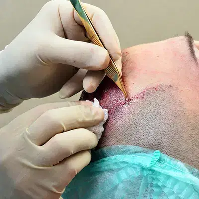 استخدام تکنسین کاشت مو جهت کلینیک کاشت مو در تبریز