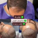 آمورش رایگان کاشت مو در چوگیاه شیراز