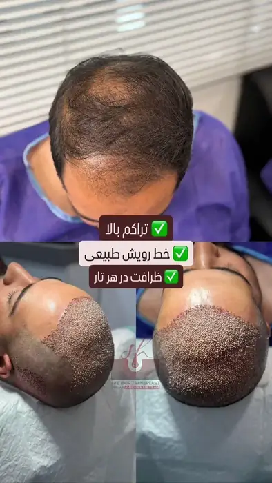 آمورش رایگان کاشت مو در چوگیاه شیراز