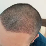 استخدام تکنسین کاشت مو جهت کلینیک پوست و مو در زنجان