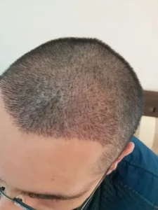 استخدام تکنسین کاشت مو جهت کلینیک پوست و مو در زنجان