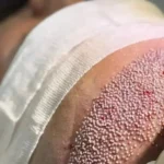 استخدام تکنسین کاشت مو جهت کلینیک زیبایی در دزفول استان خوزستان