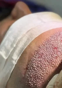 استخدام تکنسین کاشت مو جهت کلینیک زیبایی در دزفول استان خوزستان