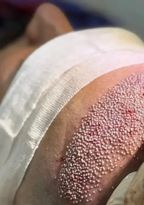 استخدام تکنسین کاشت مو جهت کلینیک زیبایی در دزفول استان خوزستان