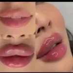 تکنسین تزریق ژل و بوتاکس هستم آماده همکاری با کلینیک های زیبایی در اهواز