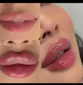 تکنسین تزریق ژل و بوتاکس هستم آماده همکاری با کلینیک های زیبایی در اهواز