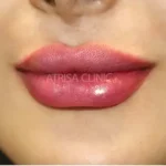 استخدام تکنسین تزریق ژل و اپراتور لیزر جهت کلینیک زیبایی در خرم آباد