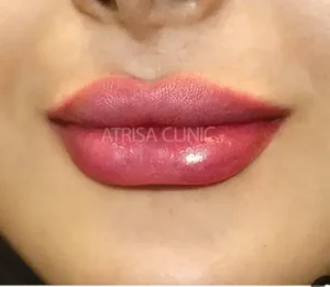 استخدام تکنسین تزریق ژل و اپراتور لیزر جهت کلینیک زیبایی در خرم آباد