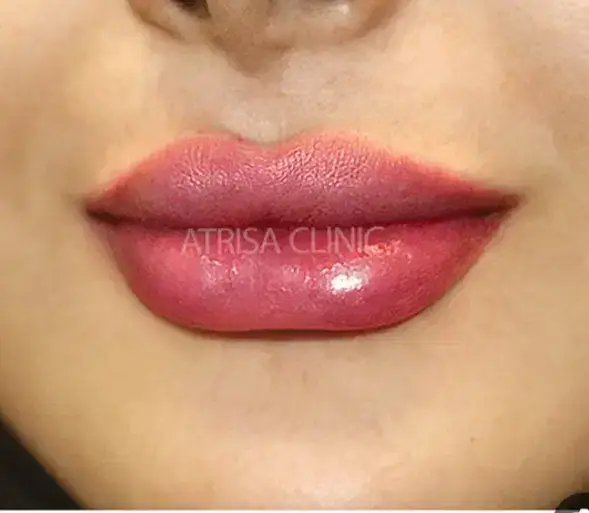 استخدام تکنسین تزریق ژل و اپراتور لیزر جهت کلینیک زیبایی در خرم آباد