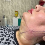 نیازمند پزشک مسلط به لیپوساکشن جهت کلینیک در تبریز