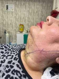 نیازمند پزشک مسلط به لیپوساکشن جهت کلینیک در تبریز