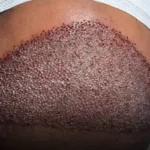 استخدام تکنسین کاشت مو جهت کلینیکی معتبر در بندرعباس