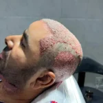 آموزش و استخدام تکنسین کاشت مو در شیراز