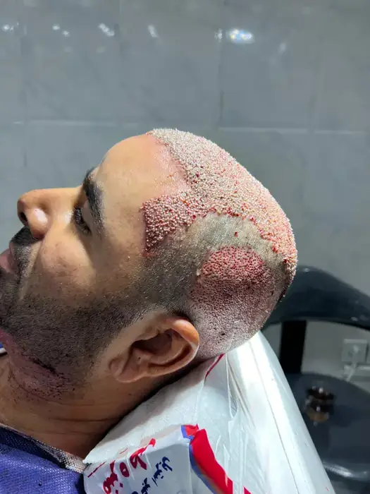 آموزش و استخدام تکنسین کاشت مو در شیراز