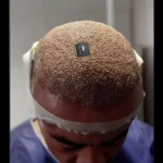 استخدام تکنسین کاشت مو و ابرو جهت کلینیک تخصصی و معتبر در مشهد