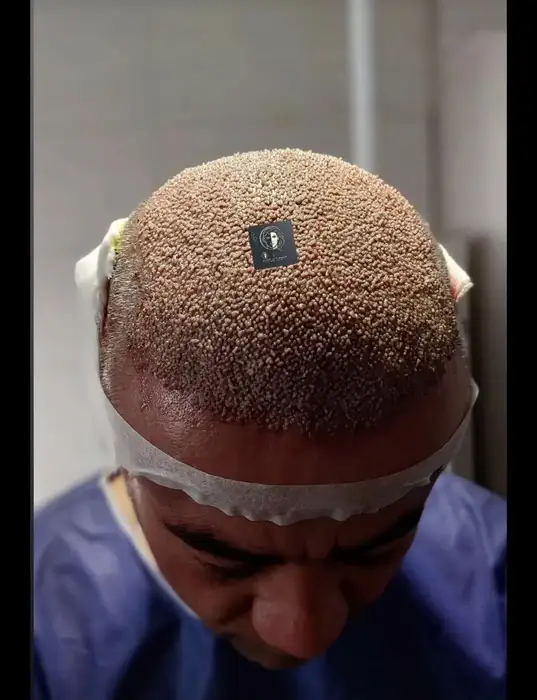 استخدام تکنسین کاشت مو و ابرو جهت کلینیک تخصصی و معتبر در مشهد