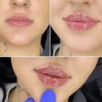 آموزش تزریق ژل و بوتاکس به همراه استخدام در بوشهر