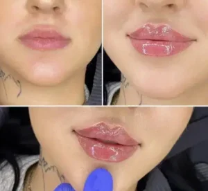 آموزش تزریق ژل و بوتاکس به همراه استخدام در بوشهر