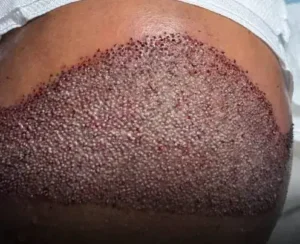 استخدام تکنیسین کاشت مو جهت کلینیک معتبر در بندرعباس