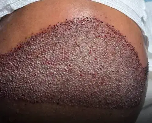 استخدام تکنیسین کاشت مو جهت کلینیک معتبر در بندرعباس