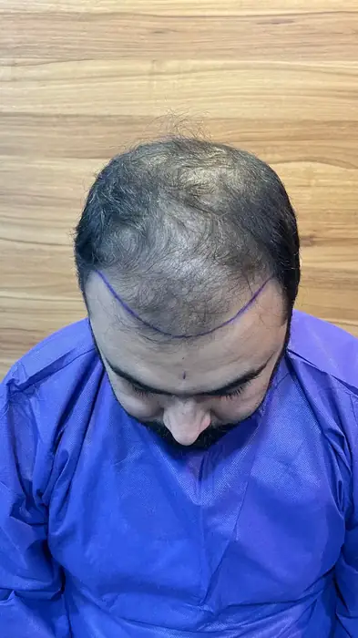 آموزش و استخدام تکنسین کاشت مو جهت کلینیک معتبر در اهواز