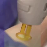 استخدام اپراتور لیزر کندلا جهت مرکز لیزر در رشت