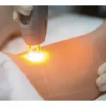 استخدام اپراتور لیزر کندلا جهت مطب فعال در کرمانشاه