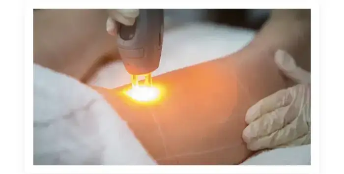 استخدام اپراتور لیزر کندلا جهت مطب فعال در کرمانشاه