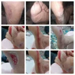 ارائه خدمات درمان زخم با استفاده از روش های نوین در استان تهران