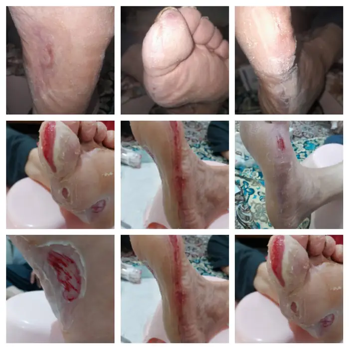 ارائه خدمات درمان زخم با استفاده از روش های نوین در استان تهران