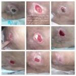 ارائه خدمات درمان زخم با استفاده از روش های نوین در استان تهران