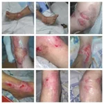 ارائه خدمات درمان زخم با استفاده از روش های نوین در استان تهران