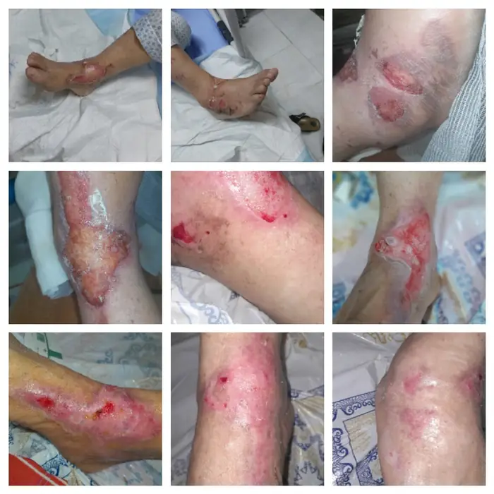 ارائه خدمات درمان زخم با استفاده از روش های نوین در استان تهران