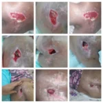 ارائه خدمات درمان زخم با استفاده از روش های نوین در استان تهران