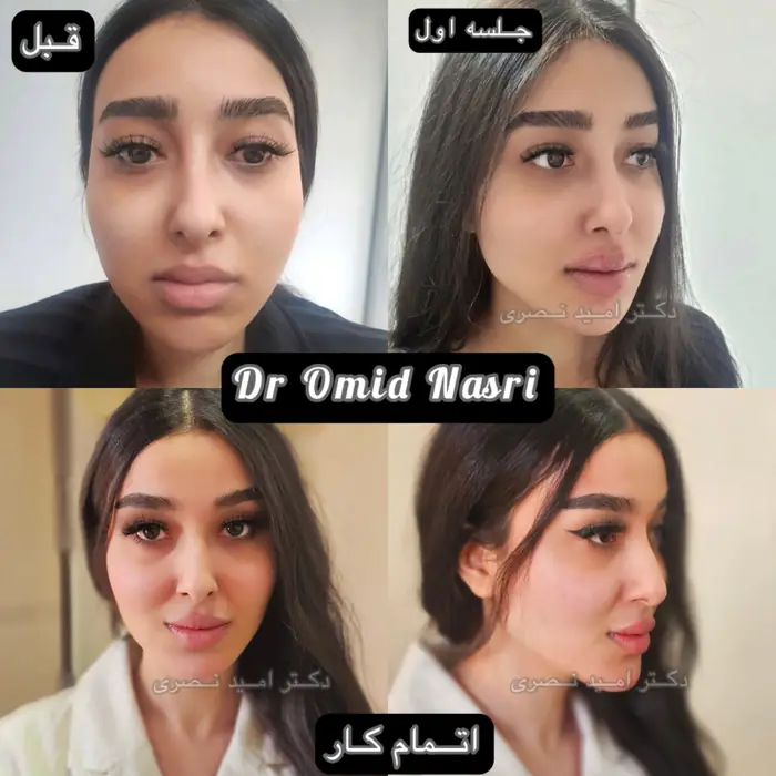 ورکشاپ آموزش فیلر و‌ بوتاکس کامل‌ صورت همراه با کار عملی در تهران