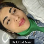 ورکشاپ تخصصی تزریق فیلر لب به همراه کیس عملی در تهران