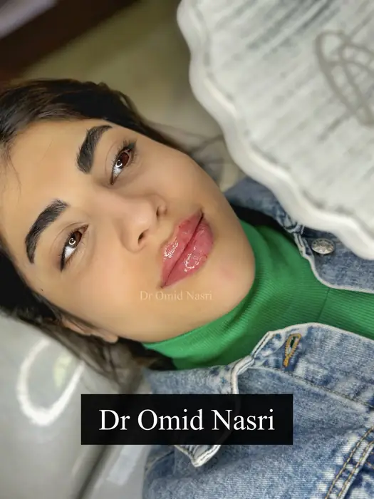 ورکشاپ تخصصی تزریق فیلر لب به همراه کیس عملی در تهران