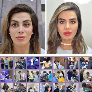 برگزاری ورکشاپ آموزش فیلر کامل صورت در تهران
